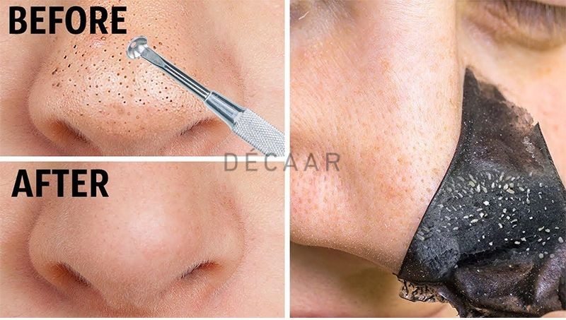 lột mụn đầu đen nhiều có tốt không